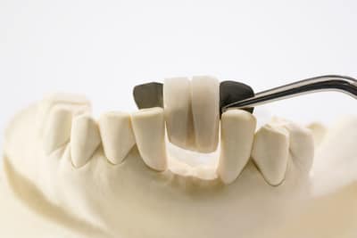 Dental bridge unit diplayed on a model made by Bendigo dental lab