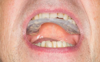 Man wearing occlusal splint to prevent teeth grinding and clenching