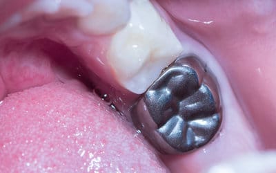 Stainlees steel baby teeth crown inserted by bendigo dentist