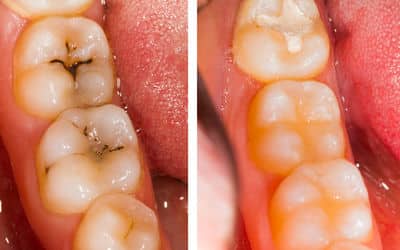 White composite filling placed in tooth cavity - before and after images