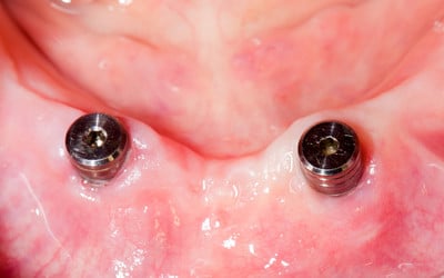 two dental implants placed in the lower jaw